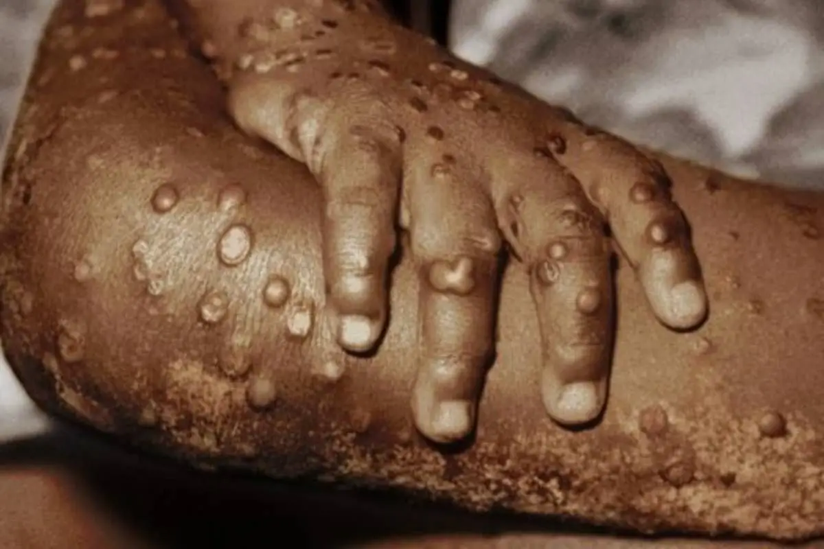 124803447_viruelasimio1.jpg, Hay 131 casos confirmados a nivel mundial.