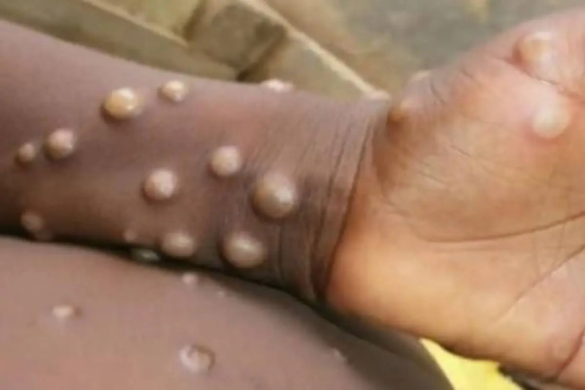 viruela-mono-espana-k3cb-620x349xabc-2.jpg, 