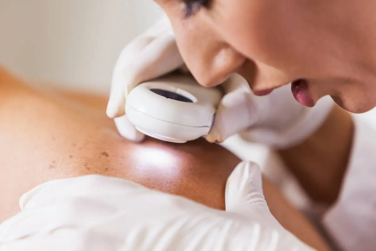Melanoma cáncer a la piel