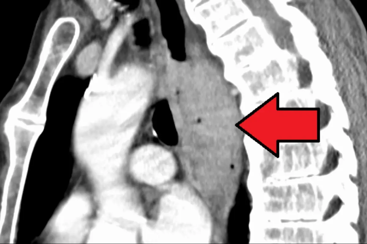 cancer-esofago, FOTO: James Heilman, MD /Wikicommons