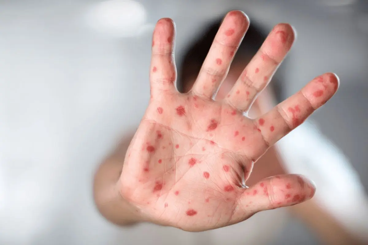 La viruela del mono enciende la alerta sanitaria, Instagram