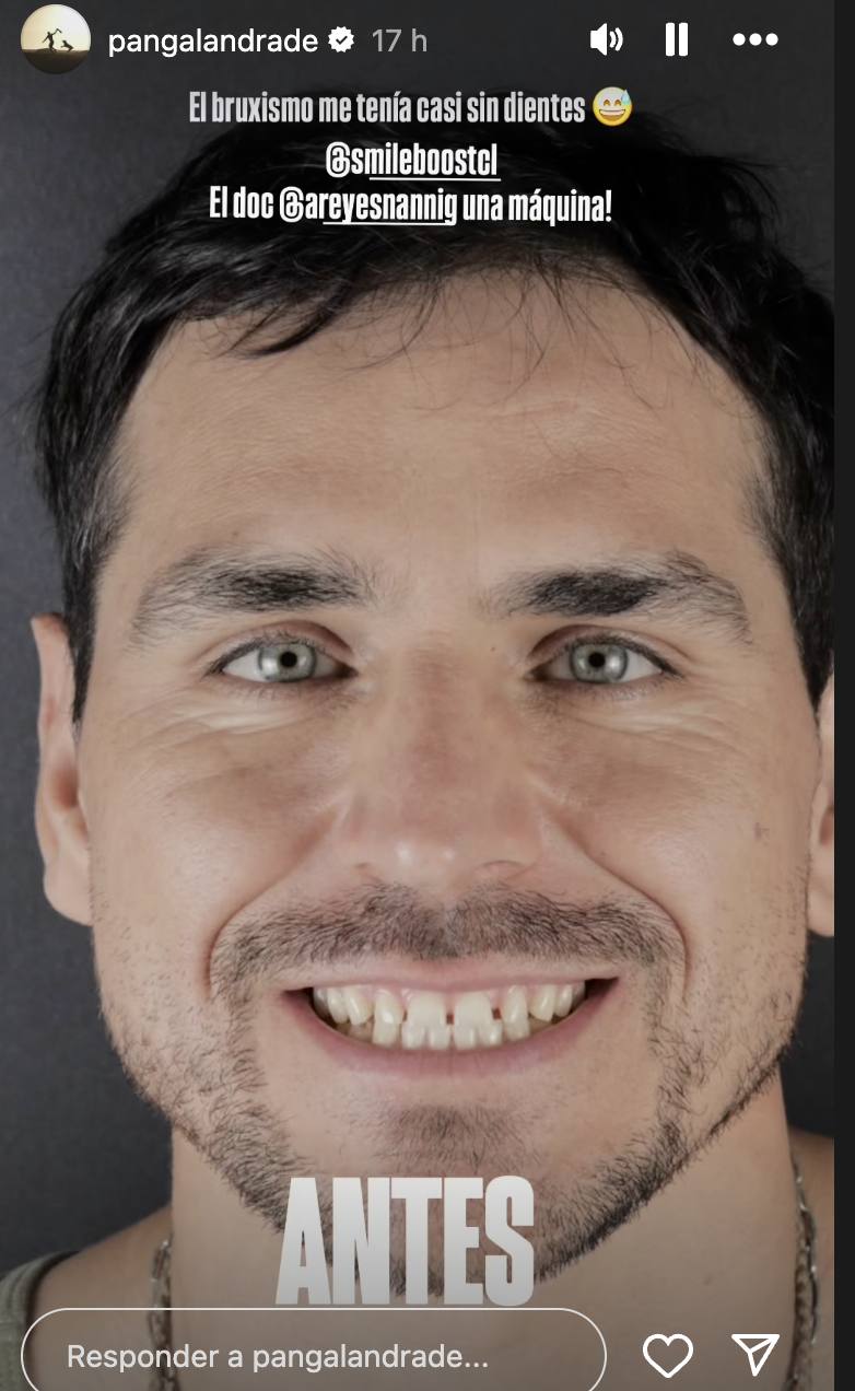 Pangal Andrade mostró su dentadura inicial - Instagram