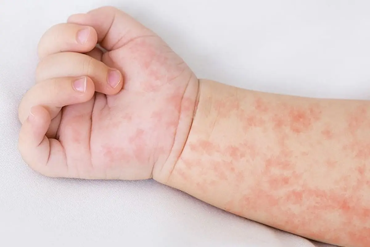 La temida fiebre escarlatina , Cedida