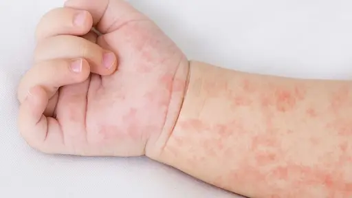 La temida fiebre escarlatina , Cedida