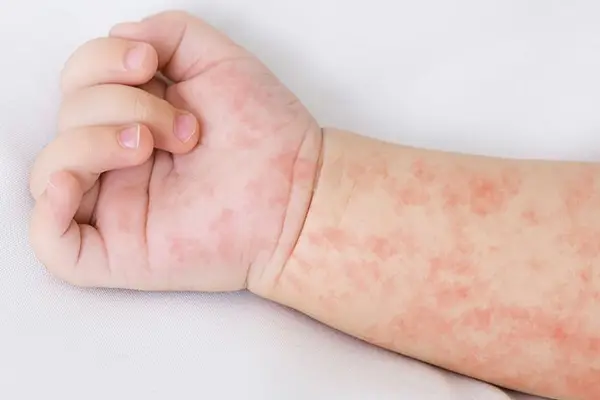 La temida fiebre escarlatina  ,Cedida
