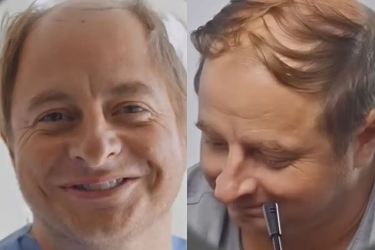 Coke Hevia lo hizo todo para revertir su calvicie, Instagram