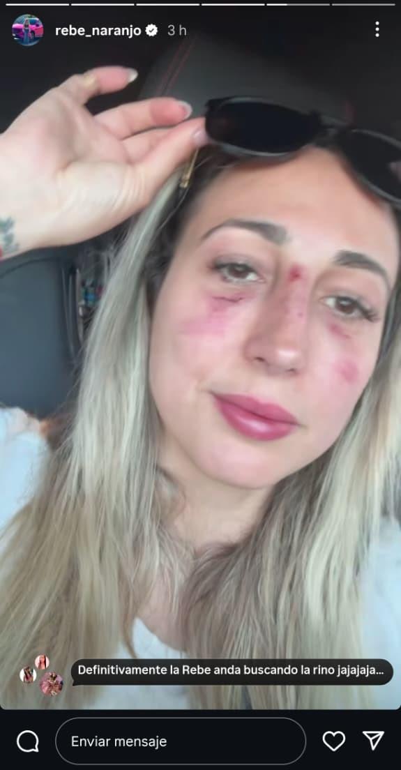 Así quedó la cara de Rebeca Naranjo - Instagram