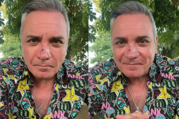 Luis Jara fue mordido por un perro ,Instagram