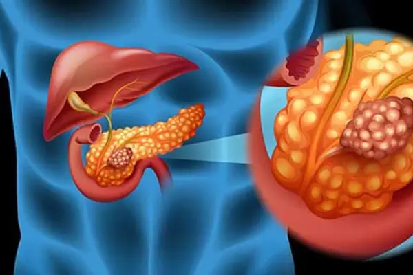 Científicos logran eliminar cáncer de páncreas en ratones ,Cadena 3 (imagen referencial)
