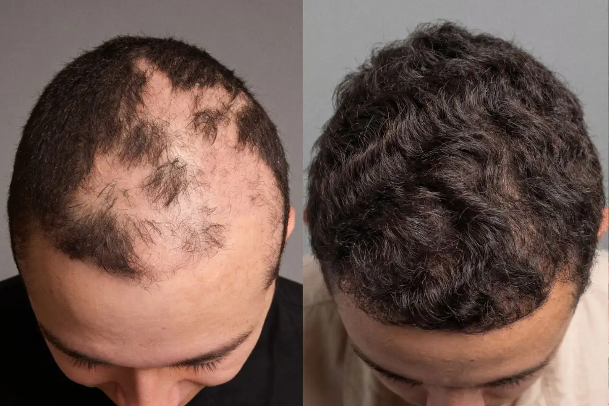 Recuperación en el cuero cabelludo, Cedida