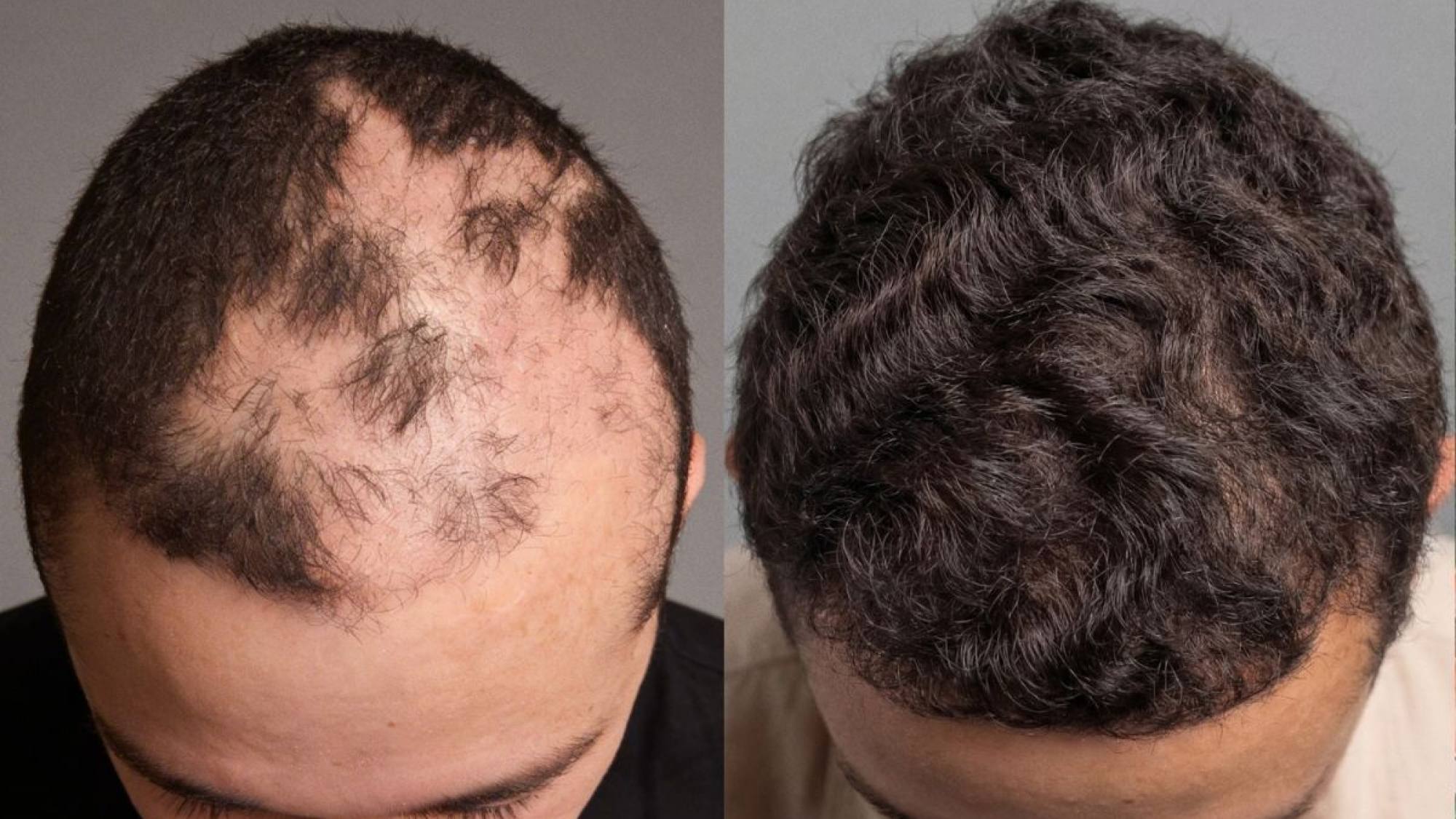 La cirugía que va más allá de la cicatriz: implante capilar gratuito reconstruye la autoestima de niños quemados