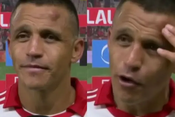 Alexis Sánchez terminó herido de guerra ,Captura