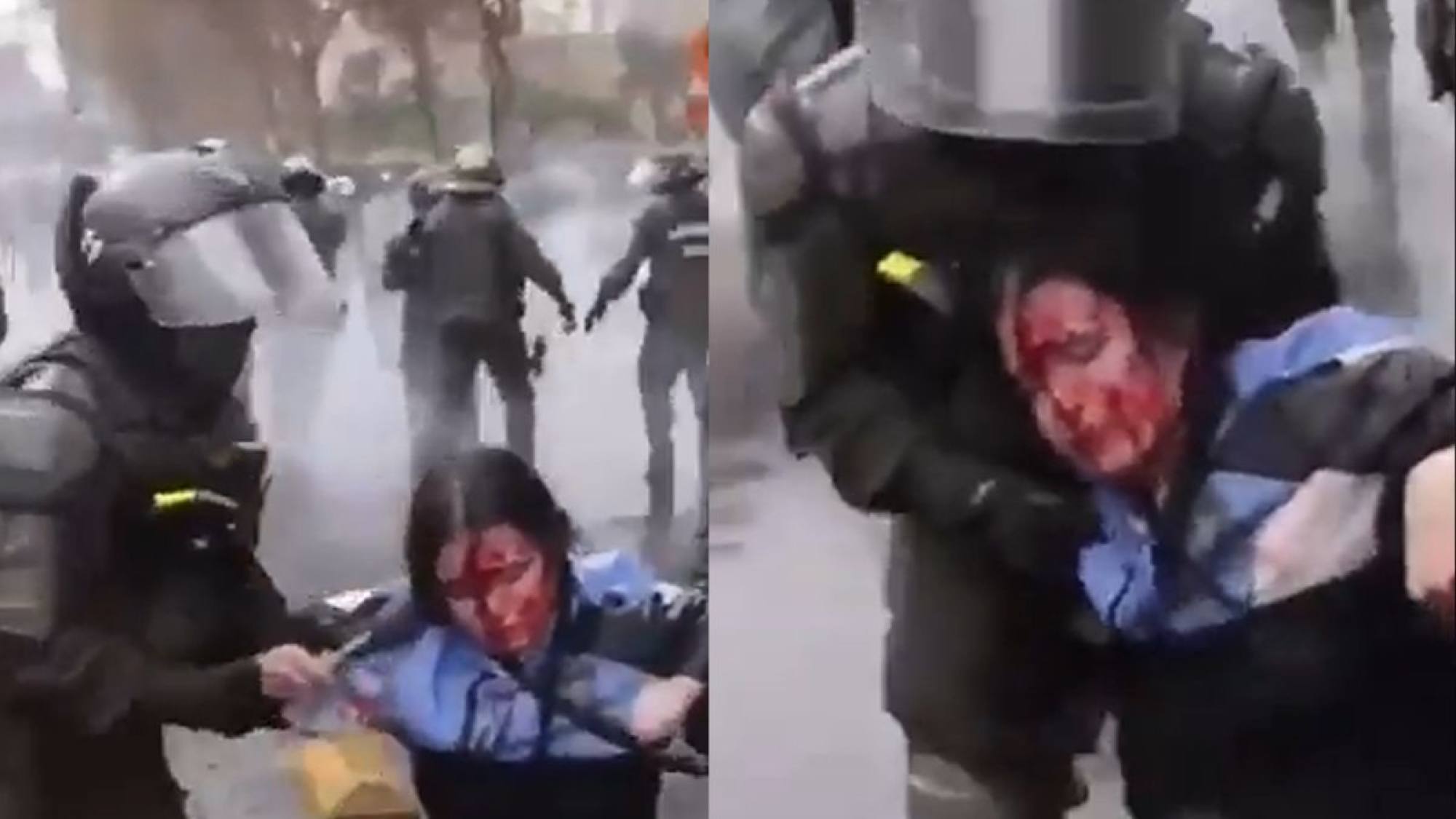 Estudiante termina con grave fracturas en su rostro en medio de manifestaciones: fue operada de urgencia