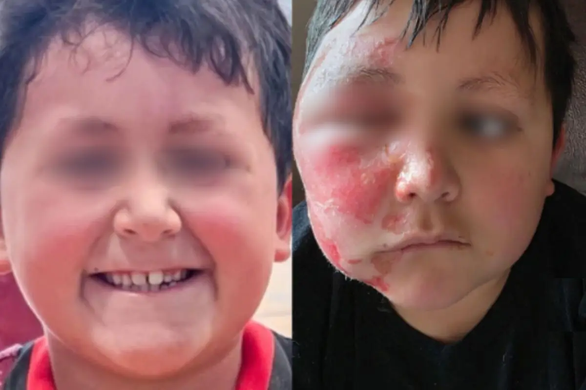 Graves complicaciones en la piel han presentado los niños, Instagram