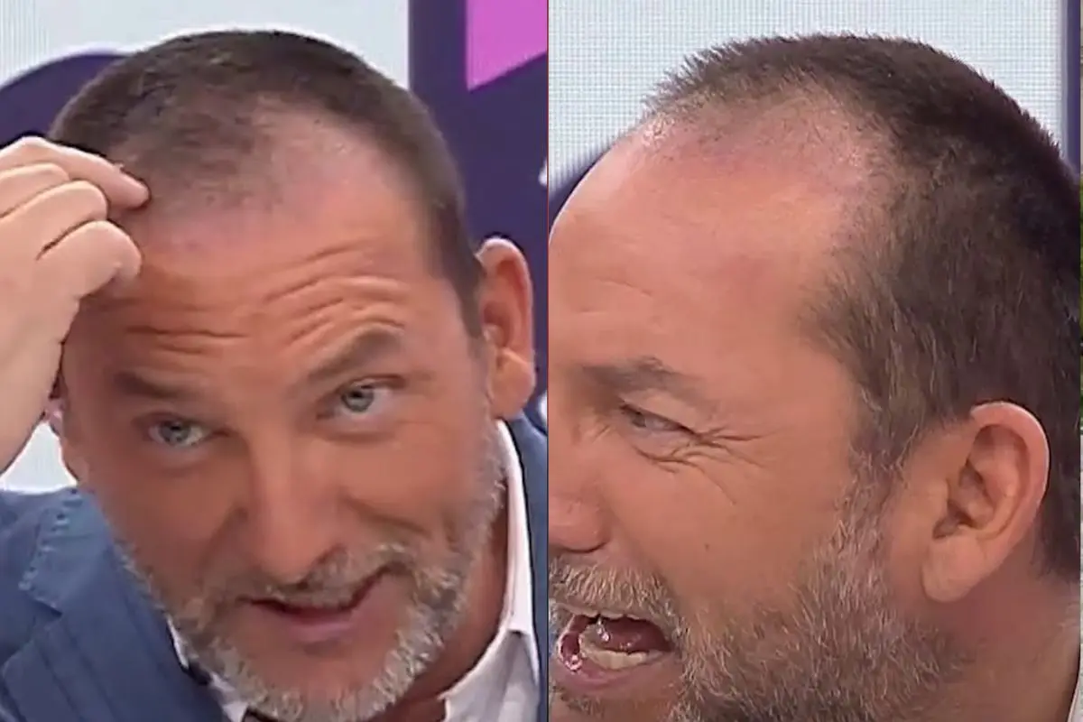 Daniel Fuenzalida mostró avances de implante capilar, Captura