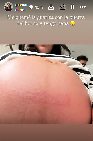 Gianella Marengo sufrió accidente doméstico - Gianella Marengo | Instagram